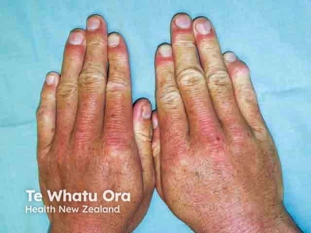Clinical photograph of bilateral hands (dorsal view) highlighting diffuse leukonychia of the fingernails associated with hypoalbuminaemia. This nail abnormality presents as white, chalky patches and diffuse whitening of the proximal nail plates with variable translucency, contrasting with normally pink nail beds. In hypoalbuminaemic states, decreased circulating albumin can lead to nail bed edema and altered keratinization, producing characteristic leukonychia (white discolouration) that may be punctate or diffuse. The image demonstrates multiple digits with whitish discoloration extending from the lunula toward the distal nail edge, without obvious onycholysis or subungual debris. Secondary vascular and cutaneous changes may accompany malnutrition, including periorbital edema or paler skin. Clinically, this finding is non-specific but serves as a surrogate marker of nutritional status and hepatic or renal protein loss, and it may improve with correction of hypoalbuminaemia. Relevance to practice includes screening for protein-energy malnutrition in hospitalized or chronically ill patients, guiding nutritional intervention, and monitoring response to therapy. Differential considerations include Mees' lines (arsenic exposure), Muehrcke's lines (transverse white bands due to hypoalbuminaemia of edema), and Terry's nails. Documentation aids educational assessment, dermatology and internal medicine training, and research into nail biomarkers of systemic disease.