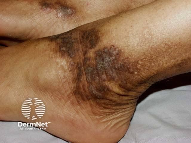 Clinical photograph of the left ankle (dermato) displaying classic features of lichen simplex chronicus (neurodermatitis) in skin of color. Modality: external photography; close-up view of medial/ankle region with oblique lighting reveals thickened, leathery plaques (lichenified skin) with accentuated markings and fissuring. The plaques show variable hyperpigmentation with darker brown to olive tones consistent with pigmented skin; surrounding skin may appear slightly erythematous and dry. Surface scales are fine-to-coarse; there is obvious hyperkeratosis, rugosity, and repeated scratching patterns. The distribution is focal to the ankle region, with potential bilateral symmetry not confirmed in this single image. The morphology includes plaques with well-demarcated borders, rough texture, and accentuated skin lines. Clinically, lichen simplex chronicus arises from chronic scratching or rubbing, leading to thickened epidermis (acanthosis) and hyperkeratosis; pruritus is common and scratching perpetuates the lesion cycle. In skin of colour, post-inflammatory hyperpigmentation can be prominent, and scale may be less conspicuous than in lighter skin. Differential considerations include plaque psoriasis, chronic eczema/atopic dermatitis, contact dermatitis, and less likely fungal infection. This image is valuable for dermatology education, teledermatology, and pattern recognition training, enabling learners to recognize chronic lichenified plaques in darkly pigmented individuals and to correlate clinical features with morphology and distribution.