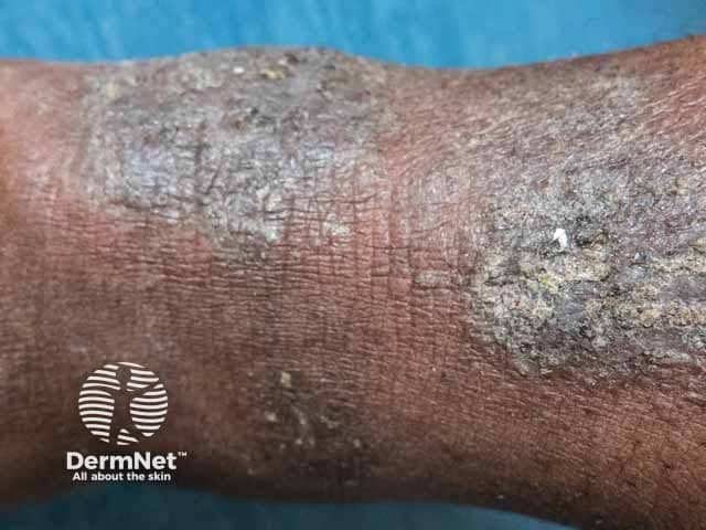 This is a high‑resolution clinical dermatology photograph of the forearm illustrating features of lichen simplex chronicus (neurodermatitis). The image shows thickened, hyperpigmented plaques with a coarse, leathery, lichenified surface and accentuated skin markings. Hyperkeratosis is evident as scale at the plaque margins, and shallow fissures may be present in the most involved areas. Erythema is mild to absent, consistent with a chronic scratching process rather than an acute dermatitis. The distribution is localized to the forearm with well‑defined, oval to elongated plaques that merge into a single broader involvement in places. The color spectrum ranges from brown to slate gray in the hyperpigmented zones, with surrounding normal or subtly inflamed adjacent skin. The morphological pattern—lesions with uniform thickness, crisp borders, and rough surface—aligns with lichenification caused by repetitive scratching and chronic itch. Clinically, this finding supports a diagnosis of lichen simplex chronicus and indicates pruritus with behavioral components. Management considerations include potent topical corticosteroids or calcineurin inhibitors, occlusion therapy, moisturizers, and itch control. Differential diagnoses include eczema/dermatitis, psoriasis with postinflammatory changes, lichen planus, and chronic contact dermatitis. This image supports education, diagnosis, and teledermatology discussions, and may accompany clinical history to guide treatment decisions and follow‑up.
