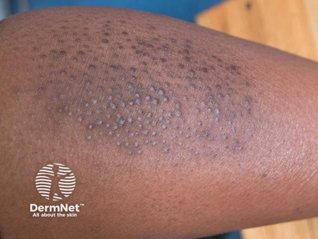 This is a high-resolution clinical photograph of the skin on the shin showing a localized plaque of lichen simplex chronicus with an overlying field of numerous small papules. The image captures a crural region lesion characterized by thickened, lichenified skin with variable hyperpigmentation and surface scale. Interspersed within the plaque are densely packed papules, each approximately 1–3 mm in diameter, with a dome-shaped to flattened contour and a pale or slightly keratotic appearance. The papular component likely reflects an exaggerated pruritus-driven scratching response, producing secondary papulonodular irritation. The overall pattern suggests a chronic itch-scratch cycle rather than an acute inflammatory eruption. From a diagnostic standpoint, the finding corroborates lichen simplex chronicus and supports a differential that includes prurigo nodularis, papular eczema, hypertrophic lichen planus, and eczema with papules. Clinically, this image is valuable for education and comparison in dermatology, dermoscopy training (if performed), and case-based review for chronic dermatitis. Potential clinical uses include documenting lesion evolution, guiding biopsy or topical therapy, and informing patient counseling about itch suppression and skin barrier restoration. This image is most relevant to dermatology, dermatopathology correlation, and educational resources about chronic pruritic dermatoses. This image fosters practical understanding of chronic dermatitis. Useful for clinical teaching and exam case discussions.