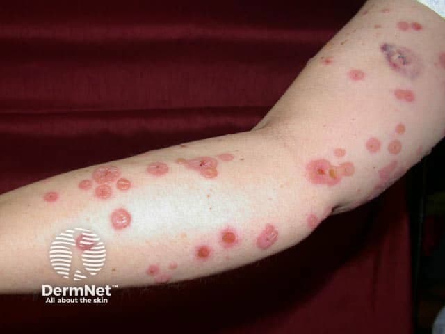 Clinical photograph of cutaneous vesiculobullous eruption on the forearm, presented as Linear IgA bullous disease (LABD). Imaging modality: clinical photography; high-resolution digital color image with close-up views to highlight individual lesions. Anatomical location: forearm skin, anterior aspect, extensor surface. Visual features include multiple discrete vesicles and bullae ranging from 2–8 mm, often on an erythematous base with surrounding edema. Lesions cluster in annular, ring-like configurations and may appear in a string of beads pattern along the limb. Some lesions show crusted centers or ruptured vesicles. The color palette is pink-red with translucent vesicular components; margins are relatively well defined, with mild superficial desquamation. The pattern is typically widespread but asymmetric, without mucosal predilection in the included image. In the appropriate clinical context, these findings are highly suggestive of IgA-mediated subepidermal blistering. Histopathology (if biopsy is performed) commonly reveals a subepidermal blister with neutrophilic infiltrate; direct immunofluorescence shows linear IgA deposition along the basement membrane zone. Diagnostic significance: the combination of characteristic clinical appearance and IgA BMZ staining supports LABD; differential considerations include dermatitis herpetiformis, bullous pemphigoid, and other subepidermal blistering diseases. Clinically, LABD often responds to dapsone or corticosteroids; pediatric cases may resolve with treatment changes. Guided management follows carefully.