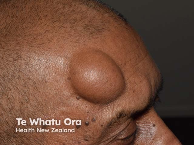 Imaging modality and technique: Clinical photography of a solitary subgaleal forehead lipoma in a living patient. Frontal- and anterolateral-view color images were captured under standard ambient lighting with no contrast or staining. Anatomical location and context: forehead (frontal region) involving subcutaneous adipose tissue beneath the galea aponeurotica in the subgaleal space; single, well-circumscribed mass protrudes through the intact skin. Visual features: dome-shaped, soft, pliable, skin-colored lesion with smooth surface margins; margins are distinct from surrounding tissues; no overlying skin changes, erythema, or signs of inflammation. Size appears several centimeters in diameter; mass is mobile with respect to the surrounding structures. Pathology suggestion: benign adipose tumor (lipoma) composed of mature adipocytes in a fibrous capsule; seen as a soft, non-tender, slow-growing lesion; no vascular pulsation or fixation to deep structures evident on photograph. Diagnostic significance: lipomas are common, benign subcutaneous tumors; important to differentiate from cysts, angiolipomas, and less likely sarcomas; management typically involves observation if asymptomatic or cosmetic concerns, with surgical excision or liposuction for definitive removal. Clinical uses: educational demonstration of superficial forehead lipoma, preoperative planning, and differential diagnosis of forehead soft-tissue masses; can guide imaging workup (ultrasound, MRI) if atypical features or rapid growth are present or evolving.