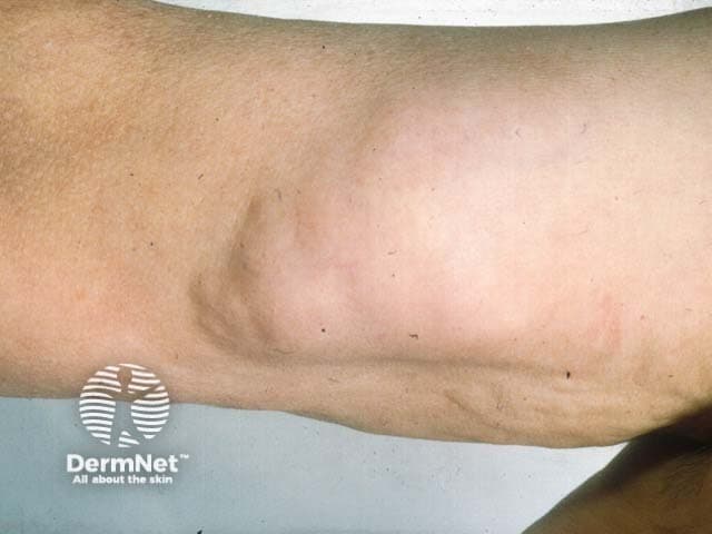 Imaging modality: Clinical photography of a soft tissue lesion. Technique: Standard color photograph of the exposed lateral upper arm without instrumentation; no contrast or illumination manipulation. Location: subcutaneous adipose tumor located in the proximal upper arm on the lateral aspect. Anatomical context: integumentary and musculoskeletal soft tissue compartment; subcutaneous fat layer with a well-defined, rounded mass measuring several centimeters in diameter; surface skin overlying the lesion is normal in color with slight skin laxity. Morphology: soft, lobulated, doughy consistency; mass is mobile beneath the skin and appears non-tender; its margins are smooth and the lesion is non-ulcerated. Pathology proxy: lipoma composed of mature adipocytes encapsulated by a thin connective tissue capsule; overlying skin shows no signs of inflammation. Clinical significance: most consistent with benign subcutaneous lipoma; differential diagnosis includes epidermoid cyst, vascular malformation, or less likely liposarcoma in enlarging or painful masses. Diagnostic use: supports clinical decision for observation or surgical excision depending on symptoms, cosmetic concerns, or functional impairment. Relevance: educational reference for clinicians, medical students, dermatology and surgery training; helpful for patient counseling and procedural planning (excisional biopsy or marginal resection). Contextual keywords: lipoma, fatty tumor, subcutaneous, upper arm, soft tissue mass, benign lesion, differential diagnosis, ultrasound/MRI correlation.
