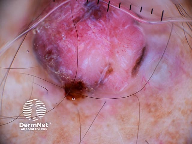 Dermoscopic imaging of a cutaneous melanoma lesion. Modality: dermoscopy (dermoscopy) using contact, non‑invasive imaging of the skin surface. The image shows a solitary pink to flesh‑colored lesion with an irregular vascular pattern, including atypical serpentine and dotted vessels, and peripheral speckling of pigment. The lesion appears with ill‑defined borders, subtle translucency, and a pale to pink background, consistent with malignant melanoma in situ progressing to invasion in some areas. The clinical appearance correlates with histopathologic Breslow depth of 8.3 millimeters, indicating a thick melanoma with high risk for regional spread and poorer prognosis. Dermoscopic clues such as atypical vascularization and peripheral pigment aggregation support a diagnosis of malignant melanoma rather than benign mimics (e.g., benign nevi, seborrheic keratosis). The image highlights key features used in triage and management: lesion asymmetry, color variability, irregular vascular architecture, and peppering pigment. Diagnostic significance: high likelihood of invasive melanoma requiring urgent excisional biopsy, staging workup, sentinel lymph node evaluation, and potential wide local excision with adequate margins. Potential clinical use cases: dermatology education, dermoscopy training, melanoma surveillance, image-based decision support, and research on color/vascular patterns in thick melanomas. Clinically, this lesion warrants histopathologic confirmation and aggressive treatment planning.