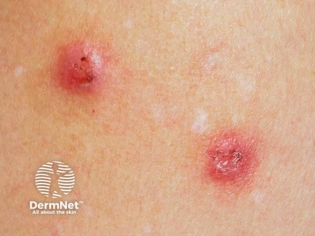 Clinical photography of cutaneous lesions showing excoriated nodules in nodular prurigo (prurigo nodularis) in a patient labeled NP-patient1. Modality and perspective: high-magnification close-up dermatologic image, noninvasive, no contrast, daylight-equivalent illumination. Anatomical location: cutaneous tissue of the skin (integumentary system); two discrete nodules with erythematous bases are visible on exposed skin. Lesion morphology: dome- or rounded-configuration nodules with central crusting, surface excoriation, and crusted tips; surrounding skin shows mild erythema without overt ulceration. Color varies from pink to reddish-brown; borders are well defined; tactile feel would be firm. If present, secondary excoriation lesions reflect chronic scratching. The features are characteristic of prurigo nodularis: chronic pruritus, intensely pruritic papules and nodules that become thickened, hyperkeratotic, and sometimes crusted due to scratching. The clinical significance lies in recognizing prurigo nodularis as a manifestation of chronic itch disorder and in distinguishing from other nodular dermatoses such as prurigo simplex, hypertrophic lichen planus, or neuropathic ulcers. Diagnostic use cases include documentation for treatment response, baseline assessment, and patient education. Potential management implications include topical corticosteroids, calcineurin inhibitors, antihistamines, and itch-control strategies. The image supports clinical correlation and dermatologic evaluation. Photographic scale and context: mark reference size and lighting conditions for reproducibility, and clinician notes.