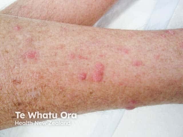 Clinical photograph of the right or left lower leg (calf) showing multiple nodular prurigo lesions on the lateral aspect. The image captures several firm, dome-shaped papules ranging from 4 to 8 millimeters in diameter, with erythematous to pink-red coloration and a slightly shiny, smooth surface. Some nodules appear crusted or excoriated, reflecting the patient's chronic scratching. The distribution is localized to the lateral calf and is irregular but clustered, without deep ulceration or pigmentary change. The surrounding skin shows mild linear or punctate scars consistent with repeated pruritus and trauma. The lesions are non-blanching and well circumscribed, with varied elevation indicating nodularity rather than flat plaques. Lighting is natural to studio-like, providing adequate detail of surface texture, color heterogeneity, and margin definition. Clinically, these findings are compatible with nodular prurigo (prurigo nodularis), a pruritic dermatosis often linked to chronic itch-scratch cycles and neuroimmune dysregulation. Differential diagnoses include lichen simplex chronicus, pruritic papular eruption, or eczema; correlation with patient history, pruritus intensity, and response to therapy is essential. This image serves educational purposes, illustrating typical nodular morphology, topography on the leg, and the appearance of excoriated nodules in chronic pruritus. Correlation with history and biopsy may confirm prurigo nodularis for assessment.
