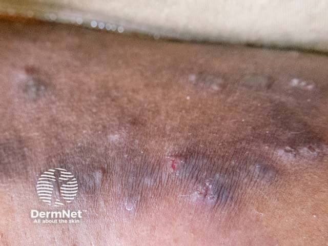 Clinical photograph of the lower leg showing features typical of nodular prurigo (prurigo nodularis) with accompanying post-inflammatory hyperpigmentation. The image captures multiple, firm, dome-shaped nodules and plaques arranged longitudinally along the anterior-lateral aspect of the leg. Lesions are hyperpigmented to brown-black, with some areas of lighter erythematous or inflamed skin and visible excoriations, crusts, and subtle scale. Surrounding skin demonstrates lichenification and diffuse dermal hyperpigmentation consistent with chronic scratching. The nodules vary in size from approximately 3 to 8 millimeters in diameter and possess a keratotic or smooth surface depending on maturity. No epistemic imaging artifacts or dermoscopic details are provided; this is a macroscopic bedside dermatology photo. The appearance is diagnostic when correlated with history of chronic pruritus and scratching, supporting a differential that includes prurigo nodularis, lichen simplex chronicus, and chronic dermatitis. The pigmentation likely reflects post-inflammatory pigmentation rather than a pigmentary disorder alone. Clinically important associations include severe itching, secondary infection risk, and possible underlying atopic dermatitis or neuropathic itch. The image is intended for educational and clinical reference, illustrating typical leg-limited distribution, lesion morphology, and the pigmentary sequelae of scratching in prurigo nodularis. Clinical correlation and biopsy may further confirm prurigo nodularis.