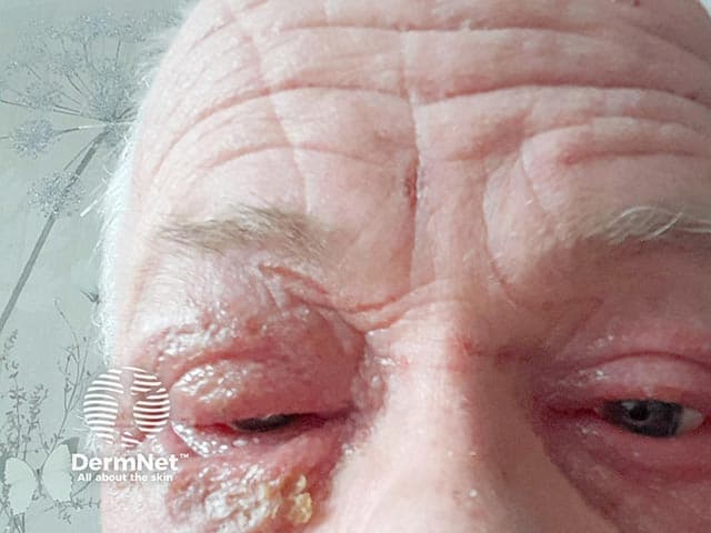 Clinical photograph of the anterior ocular adnexa showing severe blepharoconjunctivitis. Modality indicates ophthalmic photography; a close‑up frontal view of the eyelids and bulbar conjunctiva. The image depicts marked edema of the eyelid margins with diffuse hyperemia of the palpebral and bulbar conjunctiva, lash line crusting, and mucopurulent debris along the lash bases. There is conspicuous erythema, lid edema, and tearing. The anterior segment appears otherwise intact, with no obvious corneal involvement visible in this field. The appearance is consistent with acute inflammatory eyelid disease, blepharitis with conjunctivitis, and potential Dupilumab-associated ocular surface disease (OAD) given proximal timing to dupilumab initiation and rapid onset within eight weeks. Differential considerations include allergic blepharoconjunctivitis, seborrheic blepharitis, bacterial conjunctivitis, and Meibomian gland dysfunction–driven eye surface inflammation. Clinically, this image supports recognizing with high suspicion an adverse drug reaction to dupilumab presenting as ocular surface inflammation; management would focus on topical therapies, lubrication, eyelid hygiene, possible topical antibiotics if crusting/mucopurulent discharge, and coordinated care with dermatology and ophthalmology. The image is valuable for medical education, case-based review, pharmacovigilance, and research into dupilumab’s ocular adverse events and response to therapies. This documentation supports correlation with clinical history and treatment response.