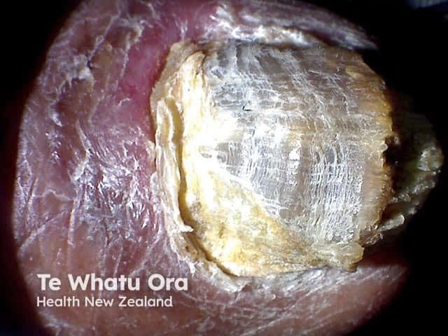 This is a dermatology clinical photograph of a toenail demonstrating total onychomycosis with complete dystrophy of the nail plate. The image captures a dorsal, macro view of the nail unit showing an extremely thickened, opaque, yellow-white to brownish nail plate with surface cracking and irregular layering. Subungual hyperkeratosis is evident with overlying rim of discolored keratin and distal lifting of the plate from the nail bed. Surrounding epidermis appears mildly inflamed or reactive. The appearance is characteristic of advanced fungal involvement (onychomycosis), typically caused by dermatophytes (e.g., Trichophyton spp.), non-dermatophyte molds, or Candida species; however, etiological confirmation requires mycological culture or microscopy. The image illustrates a severe, long-standing infection often associated with secondary bacterial colonization, discomfort, and functional impairment. Clinically relevant features include thickened plate, brittleness, discoloration, and potential subungual hyperkeratosis. This image is useful for education on differential diagnoses of nail dystrophy, including psoriasis or trauma, and for recognizing stages requiring systemic antifungal therapy versus topical management. Potential clinical use cases include patient education, dermatology training, image-based case discussions, and algorithmic scene understanding for AI diagnostic tools. It supports research into treatment response monitoring and disease progression in onychomycosis. Clinical context supports antifungal therapy planning and monitoring response effectively.
