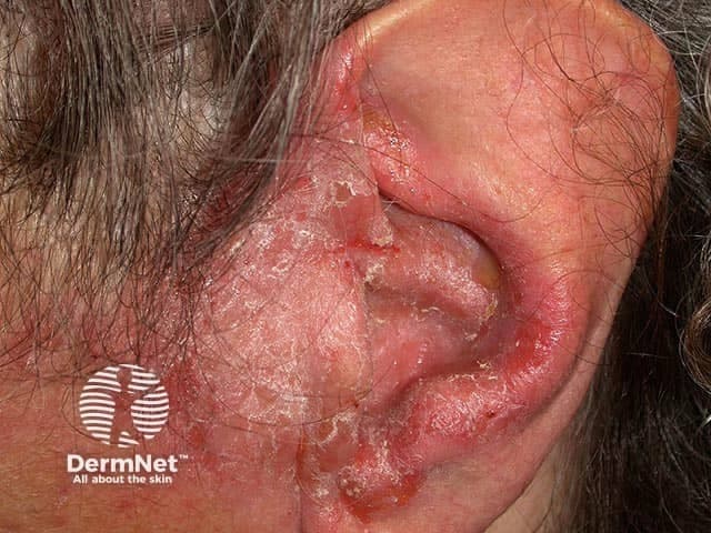 Imaging modality and orientation: this clinical photograph depicts the left auricular region, showing chronic otitis externa with extension onto the preauricular skin. Anatomical localization includes the external auditory canal entrance and surrounding preauricular soft tissue of the head and neck. Visual features include inflamed, erythematous skin with diffuse desquamation, thin adherent crusting, and fissuring around the helix and preauricular area; mild periauricular edema; no discrete mass is evident. The overall appearance is consistent with a chronic inflammatory dermatitis involving the external ear canal skin and periauricular skin. Pathophysiology entails a prolonged inflammatory process of the external ear canal skin, predisposing to fissures, excoriation, and secondary bacterial colonization; differential diagnoses include eczema/dermatitis ( seborrheic, contact, atopic ), impetigo, or cellulitis in more extensive disease. Clinical significance: the image documents disease extent, informs topical therapy choices (antibiotic plus steroid combinations), and flags potential complications such as canal stenosis or malignant otitis externa in high-risk patients. Potential clinical applications include dermatology and ENT education, tracking chronicity and response to treatment, and serving as a reference for educational case discussions and research on inflammatory skin disease of the ear. Search terms: chronic otitis externa, preauricular dermatitis, preauricular skin involvement, external auditory canal inflammation, crusting, scaling. Present.