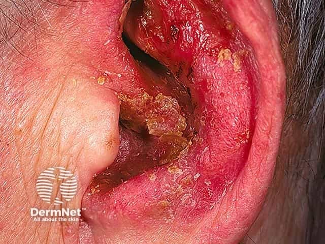 Imaging modality: Clinical photography of the external ear canal. Technique: White-light, macro close-up view capturing the external auditory canal with bright illumination to reveal mucosal color and crusting. Magnification: Macro. No contrast or staining. Acquisition parameters: Standard clinic camera settings; ambient lighting; no spectral filters. Anatomical localization: External auditory canal (EAC), part of the otic apparatus within the temporal bone; skin epithelium and mucosa lining the canal with surrounding periauricular tissues. Perspective: Close-up otologic photograph emphasizing canal lumen and canal wall margins; tympanic membrane not visualized. Clinical context: This image documents severe otitis externa with marked inflammation. Visual features include intense erythema of canal skin, edema, fissuring, and crusts or desquamation adherent to canal walls; debris may occlude the canal. Pathology involves inflammatory exudate and epithelial disruption; secondary bacterial infection is likely, and fungal infection cannot be excluded. Diagnostic significance: Confirms acute ear canal infection requiring prompt topical therapy, analgesia, and meticulous canal hygiene; urgent ENT evaluation if signs of malignant otitis externa or cranial neuropathies in high-risk patients (diabetes, immunosuppression). Differential considerations: fungal otitis externa (otomycosis), contact dermatitis, eczema, bacterial otitis externa, allergic dermatitis. Clinical correlation: Correlate with otalgia, otorrhea, hearing loss, and history of swimming or trauma; management includes culture if refractory and follow-up to ensure resolution.