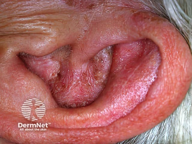 This is a high-resolution clinical photograph of the external ear (auricle/pinna) and external auditory canal region, obtained with digital photography in a frontal/anterolateral perspective. The image depicts erythema (redness) and edema (swelling) of the skin of the pinna and canal, with areas of fine to moderate desquamation and scale along the canal wall and surrounding skin. The appearance is typical of otitis externa (inflammation of the external ear canal) and may reflect concurrent superficial moisture-associated maceration. Possible etiologies include bacterial otitis externa (Pseudomonas aeruginosa, Staphylococcus species) and otomycosis (fungal infection) in humid environments; secondary bacterial infection common. The visible tissue shows no purulent discharge in this frame, though exudate can be present in other angles. The clinical significance lies in the need for targeted topical therapy (antibiotic ± steroid drops) and meticulous canal cleaning; assessment for canal edema, stenosis, or involvement of the tympanic membrane is essential; in diabetics or elderly patients malignant otitis externa should be considered if there is deep tissue involvement or systemic symptoms. Differential diagnoses include contact dermatitis, eczema, or seborrheic dermatitis of the ear. This image is relevant for education on infrared-free clinical photography of inflammatory dermatosis, diagnostic cue recognition, and treatment planning in otology and dermatology.
