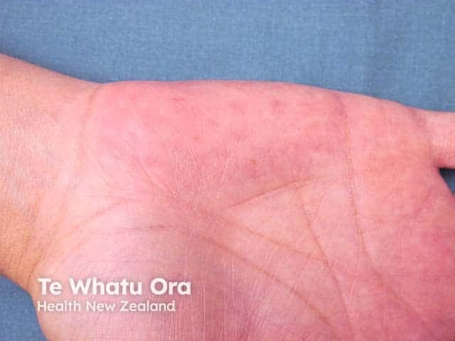 This is a clinical photograph of the palmar (ventral) surface of the hand, captured in high resolution with even illumination to document skin color. The primary subject is diffuse palmar erythema: uniform reddening of the palm, most prominent on the thenar and mid-portion of the hand, with preserved skin texture and fine palmar creases visible. No discrete lesions, vesicles, or edema are evident in the image. The redness appears transiently blanchable under pressure and may be warm to the touch, though this can only be inferred from appearance. The finding is non-specific but classically associated with systemic conditions such as chronic liver disease (cirrhosis, hepatitis), pregnancy, estrogen therapy, hyperthyroidism, autoimmune disorders, and drug reactions. Clinically relevant diagnostic significance is that palmar erythema warrants evaluation for hepatic function, hormonal status, and medication history, especially in patients with risk factors for liver disease or pregnancy. Differential diagnoses include physiologic flushing, contact dermatitis, and other causes of cutaneous hyperemia. This image is valuable for educational and research contexts to illustrate a cutaneous sign that may precede or accompany systemic illness. Potential clinical use cases include medical teaching, triage cue for liver disease assessment, and dermatology training in pattern recognition.
