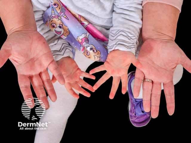 This dermatology clinical photograph captures bilateral palmar erythema on the ventral surfaces of the hands. Imaging modality: standard color clinical photography of hands; perspective: anterior/palmar view; technique: even illumination, neutral white balance; no magnification or contrast agents. Anatomy: palmar skin over the thenar and hypothenar eminences; symmetric involvement of both extremities; no cutaneous edema or desquamation. Visual features: diffuse, uniform erythema ranging from light pink to deep red, more prominent on the thenar and mid-palmar regions; skin remains smooth with no vesicles, scaling, or fissuring; nails appear normal; no signs of telangiectasia. Pathologic correlation: in the absence of systemic signs or abnormal liver function tests, this pattern is characteristic of hereditary (familial) palmar erythema, a benign genetic trait. Diagnostic significance: supports a hereditary etiology, contrasts with acquired palmar erythema seen in liver disease, pregnancy, medications; bilateral symmetry and early onset in multiple family members strengthen diagnosis. Differential considerations: acquired palmar erythema due to liver disease, endocrine or drug-induced causes, systemic inflammatory conditions; clinical correlation with family history, growth/development, and laboratory evaluation advised. Clinical use cases: dermatology teaching, genetic counseling, differential diagnosis training, radiology/pathology correlation, and longitudinal patient monitoring for family members. This image exemplifies familial, non-systemic presentation patterns for education.