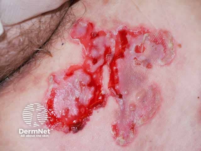 Clinical photography of a pemphigus vulgaris (PV) patient shows diffuse cutaneous erosions and ruptured, flaccid blisters with irregular edges exposing moist, erythematous bases. The close-up, high-magnification view captures superficial losses of epidermal integrity consistent with ruptured pemphigus bullae. Lesions appear tender, crusted at the periphery, and coalesce into larger erosive plaques with surrounding erythema. This presentation is classic for PV, in which intraepidermal acantholysis creates fragile blisters that rupture easily. Mucosal involvement is common in PV but is not depicted in this image. Clinically, a positive Nikolsky sign may accompany the erosions. Histologically, pemphigus vulgaris shows suprabasal acantholysis with tombstone basal cells; immunofluorescence reveals intercellular IgG. The image is relevant for dermatology, medical education, and clinical practice for recognizing active cutaneous PV and guiding management. Common treatment considerations include systemic corticosteroids, steroid-sparing immunosuppressants, and targeted biologics, with careful monitoring for flare progression. For research and training, annotate lesion age, localization, and wound characteristics, and correlate with serology (desmoglein antibodies) and biopsy findings when available. This image exemplifies PV skin involvement and supports differential diagnosis from bullous pemphigoid and other vesiculobullous diseases.