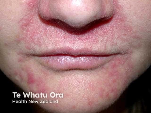 Imaging modality: Clinical photography of the face using digital color photography, frontal close-up view of the perioral region. The image depicts a live adult female (perioral skin) with erythematous, dome-shaped papules arranged around the mouth and nasal folds (nasolabial area). The perioral dermatitis pattern shows confluent erythema with scattered papules, mild desquamation, and sparing of the vermilion border. Skin texture is slightly rough with subtle edema. The distribution is perioral and nasolabial, with sparing of the periocular region; no obvious comedones are prominent. The lesion morphology includes small, reddish papules, possibly pustules in several focal points, consistent with inflammatory papules rather than cystic nodules. No biopsy is shown; histology would likely reveal superficial perifollicular infiltrates and dermal edema in dermatitis, though clinical diagnosis is based on distribution and response to therapy. Clinically significant as perioral dermatitis is commonly associated with topical corticosteroid exposure and irritant skincare; misdiagnosis as acne can lead to inappropriate antibiotic or retinoid therapy. This image is relevant for dermatology education, differential diagnosis practice (acne vulgaris, rosacea, contact dermatitis), and therapeutic planning (steroid withdrawal, metronidazole or doxycycline). It demonstrates characteristic perioral papules, lip-chin region involvement, and the need to consider drug history, facial dermatoses, and patient counseling.