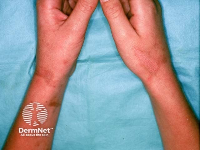 Clinical photography demonstrates bilateral forearm skin with residual post-inflammatory hyperpigmentation following phytophotodermatitis. The image, captured in a standard clinical setting with even room lighting, shows multiple irregular, brown to reddish-brown macules and patches distributed along sun-exposed forearm surfaces. There is minimal surrounding erythema, consistent with a quiescent or resolving phase after an acute phototoxic eruption. The pigmentation is mottled and can appear reticulated in places, reflecting prior inflammatory injury to the epidermis and superficial dermis. The pattern often tracks lines or contact with plant juice (furocoumarins) and sunlight, producing linear or streak-like hyperpigmented bands that gradually fade over months. No vesiculation or active edema is evident in this image; there may be faint residual accentuation on the wrists and dorsal forearms. Clinically, this appearance is typical of post-inflammatory hyperpigmentation after phytophotodermatitis and has relevance for prognosis and counseling. Differential considerations include other causes of PIH such as melasma, solar lentigines, or pigmentary contact dermatitis; however, the distribution and history support a phototoxic etiology. Management focuses on photoprotection, barrier care, and gradual pigment clearance; dermatologic follow-up may be necessary to document improvement and address cosmetic concerns. This image serves educational and comparative purposes for dermatology training and patient counseling and documentation.