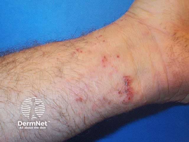 This clinical dermatology photograph shows a close-up view of the volar wrist with evidence of healing phytophotodermatitis. The image captures post-vesicular sequelae including faint erythema, superficial crusts, and residual post-inflammatory hyperpigmentation along a linear pattern across the wrist and distal forearm. The modality is high-resolution digital photography used in dermatology clinics to document cutaneous reactions to photosensitizing plant juices during sun exposure. The anatomical location is the volar aspect of the wrist; epidermal and superficial dermal changes are consistent with healing inflammatory injury, leaving pigmentary changes and minor scarring. In the acute phase, vesicles or bullae form at sites of contact and UV illumination; in this image, healing is evident with crusts and pigment, without extensive edema. Diagnostic significance includes recognition of phytophotodermatitis, a phototoxic/ photoallergic skin reaction triggered by plant-derived furocoumarins or psoralens exposed to ultraviolet radiation. The image is relevant for educational demonstrations of differential diagnoses: contact dermatitis with photosensitivity, linear pigmentary dermatitis, and post-inflammatory hyperpigmentation. Potential clinical use cases include patient education on phototoxic risk, documentation for dermatology training, and research on resolution timelines of pigmentary sequelae after vesicular eruptions. Pattern recognition supports counseling on sun protection and avoidance of identified plant exposures.