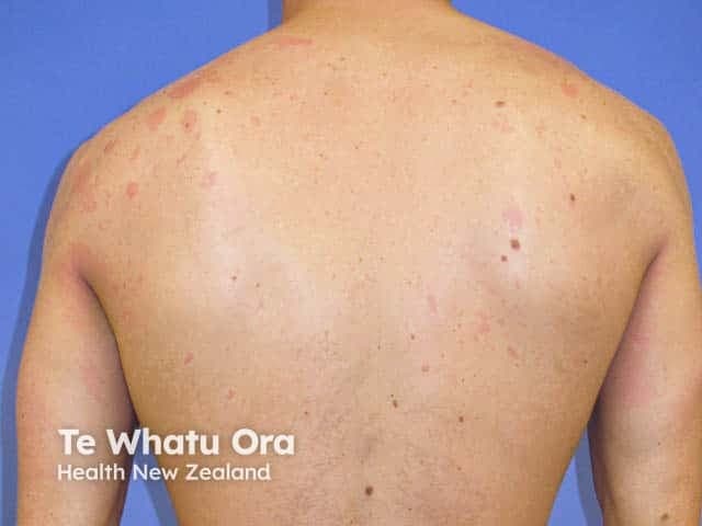 Clinical photography of the back demonstrating phytophotodermatitis. The dorsal trunk displays multiple erythematous macules and patchy plaques with variable edema and mild superficial desquamation; some areas show postinflammatory hyperpigmentation. Lesions are distributed unevenly, with occasional linear or streak-like patterns suggesting prior contact with plant sap, fruit juice, or essential oils and subsequent ultraviolet A (UVA) irradiation. The overall appearance is nonpurpuric and nonbullous in this image, though phototoxic reactions can blister in acute stages. The skin shows a pale in-texture; no obvious vesicles are present here. The patterning is consistent with a phototoxic interface reaction rather than an immune-mediated contact dermatitis. The patient’s exposure history, outdoor activity, and potential contact with citrus fruits, celery, fennel, bergamot, or other furocoumarin-containing organisms should be evaluated. Postinflammatory hyperpigmentation may persist for weeks to months. Clinically, phytophotodermatitis is diagnosed by history and pattern recognition; biopsy is rarely required. This image is useful for education about sun-exposed, plant-associated phototoxic reactions, differential diagnoses such as other photosensitivities, and for illustrating the classical streaking distribution. It supports clinical decision-making regarding avoidance of triggering plants, photoprotection, and topical anti-inflammatory therapy when indicated. Educational value includes recognizing pattern recognition, teaching exposure history, and documenting phototoxic risk factors for clinicians.