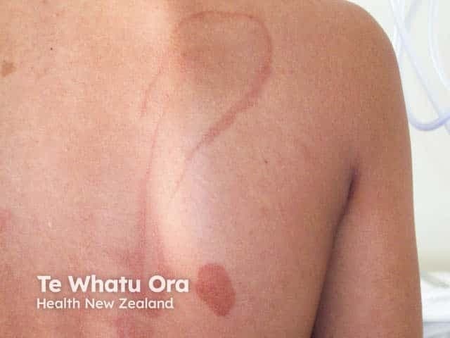 This dermatologic image shows a dorsal trunk clinical photograph of phytophotodermatitis produced by contact with lime juice and subsequent sun exposure. Modality: clinical photography; No contrast. The focal points are linear, pigmented streaks and erythematous patches corresponding to areas of juice exposure on the left upper back and scapular region, extending medially toward the midline. Early findings include superficial erythema and slight edema; later findings show brown tan hyperpigmentation along the same linear distribution. The pattern is distinctive: streaks rather than irregular patch; margins are relatively well-defined and asymmetrical. The pathophysiology: photosensitizing furocoumarins (psoralens) in citrus juice transfer to the skin and, upon UVA exposure, generate reactive oxygen species causing epidermal damage and melanin deposition, resulting in post-inflammatory hyperpigmentation. Clinically, this condition mimics contact dermatitis but follows a photodistributed, streak-like pattern. Diagnostic significance: history of lime juice exposure, sun exposure, and a linear pattern; differential includes contact dermatitis from other citrus components, berloque dermatitis, photodermatoses, and pigmented contact dermatitis. Potential clinical use: educate patients on phototoxic contact reactions; differentiate from sunburn; monitor for persistent hyperpigmentation. This image aids dermatology education and phototoxicity recognition in emergency and primary care settings.