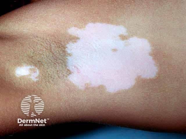 Clinical photography of axillary skin showing depigmented vitiligo patches. Modality: Clinical photograph, dermoscopy not used. The image depicts a large, well-demarcated, chalk-white macule/patch centered in the axillary fold with irregular but sharply defined borders. Adjacent skin exhibits relative hyperpigmentation surrounding the patch, consistent with repigmentation margins typical of vitiligo-affected areas. The surface appears smooth, non-scaly, and non-erythematous, with no crusting or ulceration. Hair within the depigmented areas may be reduced or absent, although follicular retention can occur. Lesions are unilateral and localized to the axilla in this view; a second smaller depigmented area is visible nearby. The clinical impression is consistent with localized vitiligo (leukoderma) presenting as hypopigmented to depigmented patches due to melanocyte destruction. The absence of scale distinguishes vitiligo from tinea versicolor or eczema; the uniform whiteness under standard lighting supports vitiligo rather than postinflammatory hypopigmentation. This image is relevant for educational descriptions of vitiligo morphology, differential diagnosis (hypopigmentation variants, pityriasis versicolor), and for demonstrating axillary involvement. Potential clinical utility includes patient counseling, Wood lamp correlation, and monitoring treatment response to topical corticosteroids, calcineurin inhibitors, or phototherapy over time. Image serves as a reference for clinicians evaluating depigmented lesions and educating patients about prognosis.