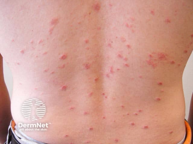 This is a high-resolution clinical photograph of the dorsal trunk showing a mildly symptomatic pityriasis rosea eruption. The image captures numerous discrete erythematous to pink papules and plaques on the back, many displaying fine overlying scale concentrated at the periphery (collarette scale). Lesions are small to medium in size (roughly 3-6 mm) and arranged diffusely across the posterior torso, without mucosal involvement. The distribution is characteristic for pityriasis rosea, with trunk predominance and a tendency to align along cleavage lines, producing a subtle christmas tree pattern in classic cases, though such configuration may be less evident in isolated back photographs. The coloration is uniform, with slight central clearing in some lesions and a flatter, smooth surface in others. No vesiculation, crusting, or purpura is evident. The image does not reveal the herald patch, which may precede or accompany the eruption. This photographic record is intended for dermatology education, differential diagnosis training, and clinical pattern recognition; it supports rapid recognition of PR versus mimickers such as tinea corporis and psoriasis. The image could be used in teaching modules, teledermatology consultations, and AI-based pattern recognition research to improve diagnostic accuracy and triage in skin-of-color presentations when available.