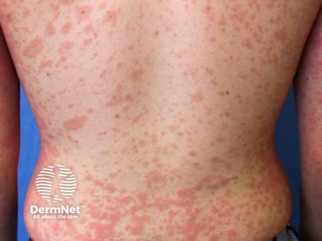 Clinical photograph of the back demonstrating pityriasis rosea-like eruption. High-resolution color image capturing multiple oval annular plaques with salmon-pink hue and fine collarette scaling along the trunk. The long axis of each lesion is oriented approximately parallel to the ribs, creating a pattern that follows the thoracic dermatomal distribution on the dorsal chest and flanks. Lesions are predominantly superficial, ill-defined at the periphery, with central clearing and variable sizes ranging from several millimeters to a centimeter. The overall appearance is erythematous, mildly pruritic, and arranged in a trunk-centered, zigzag or Christmas tree distribution, typical of pityriasis rosea. Differential considerations include tinea corporis, pityriasis versicolor, guttate psoriasis, and nummular eczema. Clinically, this presentation supports the diagnosis of pityriasis rosea when accompanied by a herald patch or secondary eruption; histopathology is not provided. The image is intended for education, differential diagnosis training, and radiological-free dermatology research; useful for teaching pattern recognition, dermography, and dermatoepidemiology. The photograph emphasizes trunk involvement with characteristic collarette scaling, aiding clinicians in distinguishing PR from mimickers and in counseling patients about the self-limited course (usually 6-8 weeks) and symptomatic management options. No systemic symptoms are evident; findings support a benign, self-limited cutaneous eruption in most cases for clinicians.