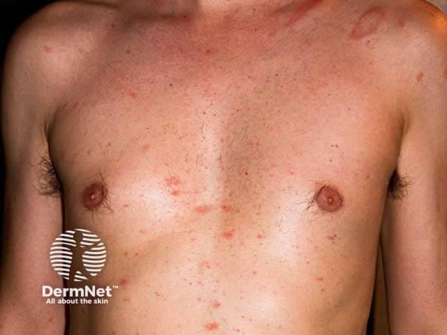 Clinical photography of the skin in an adult male demonstrating pityriasis rosea with a herald patch on the left shoulder and a secondary eruption across the anterior trunk. Modality: Clinical color photograph of cutaneous lesions. Anatomical location: trunk and left shoulder; body region: anterior chest, shoulders; left shoulder herald patch. Visual features: a focal, oval, erythematous patch with a fine, peripheral, collarette scale characteristic of a herald patch, measuring several centimeters in diameter; surrounding smaller, discrete, pink-to-reddish papules and plaques arranged along the trunk in a roughly perpendicular or 'Christmas tree' distribution. The skin surface shows mild surface scaling, slight erythema, and no purulence or crusting. The overall appearance is consistent with pityriasis rosea in the classic stage, with the herald patch preceding or accompanying generalized lesions. Diagnostic significance: This pattern supports a self-limited, benign inflammatory dermatosis with uncertain etiology, possibly viral (HHV-6/7) association; prognosis is favorable, treatment typically supportive (emollients, anti-pruritics). Differential diagnoses include tinea corporis, pityriasis versicolor, secondary syphilis, and eczema. Clinical correlation is important: young adults, acute onset, trunk-dominant rash, PR often resolves in 6-8 weeks. This image is useful for education, pattern recognition, and dermatology teaching materials regarding herald patch and classic pityriasis rosea presentation criteria.