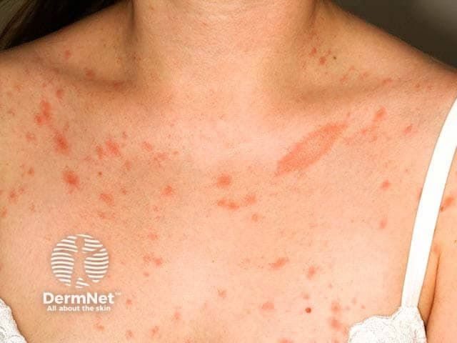 Clinical dermatology photograph of the upper back and posterior neck demonstrates classic pityriasis rosea with a herald patch. The main lesion is a solitary, oval, salmon‑pink plaque with fine, collarette scaling along the outer margin. The lesion size is larger than subsequent papules and appears slightly raised with less surface involvement centrally. Surrounding the trunk shows numerous smaller erythematous papules and plaques distributed in a crest-like or zigzag pattern consistent with secondary eruption along Langer's lines, sometimes described as a Christmas tree distribution on the torso. Coloration ranges from pink to coral; scaling is peripheral and secondary lesions may be pruritic. The overall clinical impression is pityriasis rosea in an early or evolving stage, with herald patch indicating onset often preceding generalized eruption by days to weeks. Differential considerations include tinea corporis and secondary syphilis, which can resemble patchy erythema and collarette scaling; correlate clinically and with serology if indicated. The image highlights typical dermatologic features such as circinate patches, mild edema, and intact epidermis without crusting or vesiculation. This presentation is self-limited, benign, and usually resolves within 6–8 weeks with symptomatic care. Reassurance and avoidance of irritants are appropriate management, with follow-up to ensure resolution. If lesions persist or patient reports systemic symptoms, consider dermoscopic evaluation and confirmatory testing as indicated. Early diagnosis guides management decisions.