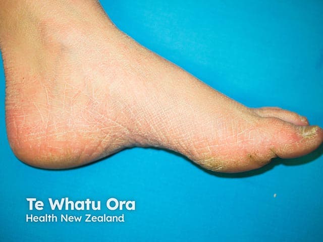 This is a macroscopic clinical photograph of the plantar aspect of the foot, captured for dermatology/foot-health assessment. Imaging modality: Clinical photography; technique: high-resolution color image of the sole, direct view, with standard diffuse lighting and no magnification. Anatomical location: Plantar surface of the hindfoot and midfoot, primarily the heel region, extending to the medial plantar arch. Visual features: a red-orange to pink-tan hyperkeratotic plaque with a thick, rough surface and fissuring; surrounding hypochromic to xerotic skin; margins are relatively ill-defined but the lesion remains clearly localized to the plantar skin. The lesion appears as a diffuse keratotic patch rather than a single discrete nodule, with variable thickness across the plantar surface. Pathology (clinically): evidence of epidermal hyperplasia with thickened stratum corneum (hyperkeratosis) and surface fissures, typical of friction-induced plantar keratopathy; no signs of vesiculation, purulence, or acute inflammation evident. Diagnostic significance: characteristic of friction-related plantar hyperkeratosis or callus; differential considerations include plantar corn, plantar wart (verruca plantaris), and diffuse plantar keratoderma; correlate with symptoms and history. Clinical correlation: evaluate footwear, gait, pressure points, activity level; screen for diabetes risk; may respond to keratolytics, debridement, padding, and orthotic optimization; useful for monitoring response to therapy and for educational and research material.