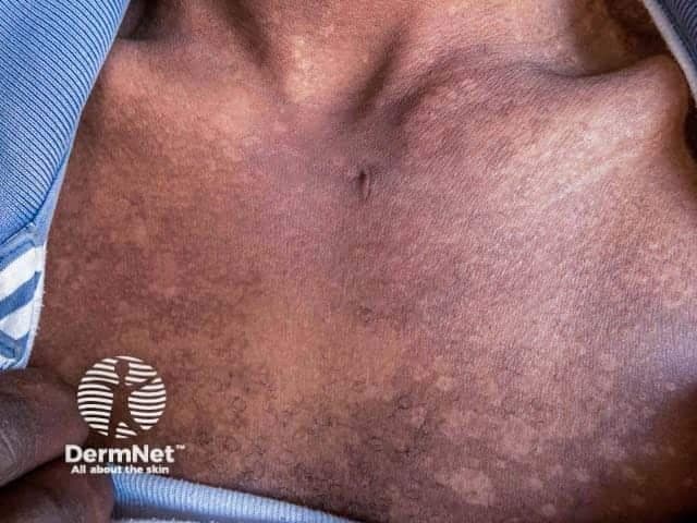 Clinical photography of the anterior trunk in a patient with pityriasis versicolor presenting in the hypopigmented stage. High-resolution, color-balanced digital image captured under standard visible light to document surface skin changes on the chest and upper abdomen with an anterior view. The lesions appear as numerous flat, ill‑defined macules with a pale to slightly hypopigmented hue relative to surrounding skin. The patches are variably coalescent, with fine scale evident at the margins and mild asynchronous tan response in adjacent areas. The distribution favors the central chest and proximal trunk, presenting as asymptomatic patches without erosion or crusting. Dermatoscopic features are not available; the surface is smooth, with subtle textural changes rather than prominent edema or vascular markings. Clinically, pityriasis versicolor is a superficial Malassezia yeast infection that disrupts melanin production, producing hypopigmented or hyperpigmented macules depending on skin type. The image illustrates hypopigmented lesions characteristic of the disease, aiding differential diagnosis from vitiligo, post-inflammatory hypopigmentation, and pityriasis alba. This image supports clinical correlation with Wood’s lamp examination, which often reveals copper-orange fluorescence in affected skin, and with mycological confirmation via KOH preparation showing spaghetti-and-meatballs. Potential clinical applications include education, dermatology training, and research on pigmentary disorders and superficial fungal infections.