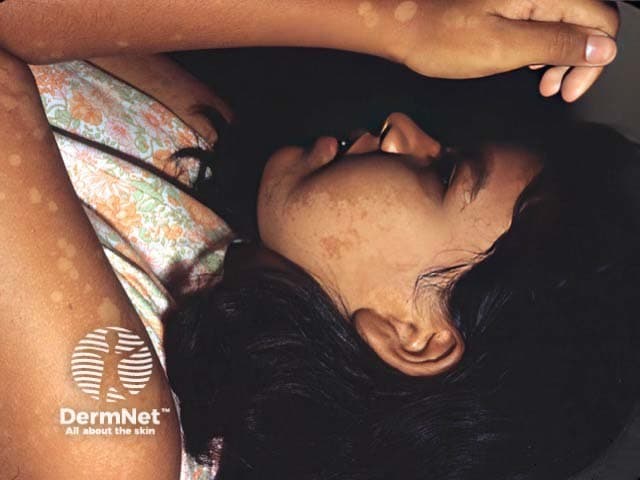 This dermatology clinical photograph depicts hypopigmented patches consistent with pityriasis versicolor (tinea versicolor) involving sun-exposed skin on the face and forearm of a patient labeled PV-patient1. The lesions appear as flat, well-demarcated, hypoesthetic macules with subtle surface scale. Facial patches are lighter than surrounding skin, while forearm lesions show a similar pigmentary disturbance. The appearance is characteristic for PV, caused by superficial Malassezia overgrowth that metabolizes lipids, producing pigmentary changes in the stratum corneum. Sun exposure can accentuate hypopigmentation, and Wood’s lamp examination may reveal fluorescence supportive of diagnosis. Clinically, recognize it as a benign, treatable dermatosis that should be differentiated from vitiligo, pityriasis alba, and post-inflammatory hypopigmentation. Management typically includes topical antifungal therapy (ketoconazole, itraconazole, terbinafine) or selenium sulfide, with potential recurrence. This image serves educational purposes in dermatology training, remote assessment, and AI-driven lesion recognition, illustrating characteristic distribution on the face and arms, the macular morphology, and the essential differential diagnoses in pigmentary disorders.