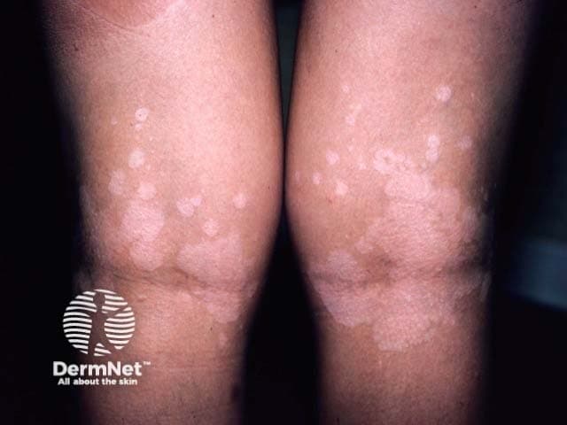 Clinical photography of bilateral popliteal fossae demonstrates multiple hypopigmented, well-demarcated macules and patches, some coalescing into larger plaques, distributed in flexural folds behind the knees. The lesions are lightly scaly on close inspection, or may show parchment-like scale in certain lighting. The overall appearance is typical for pityriasis versicolor (Malassezia) with hypopigmented variants; flexural involvement is recognized in some cases. Skin outside the lesions remains normal in tone; no erythema, atrophy, or induration is present. Images were captured with standard clinical photography setup, using diffuse neutral lighting to maximize contrast between hypopigmented patches and surrounding skin. The clinical impression is hypopigmented pityriasis versicolor; differential considerations include postinflammatory hypopigmentation, tinea versicolor in intertriginous zones, pityriasis alba, vitiligo in flexures, eczema, or hypopigmented mycosis. Confirmation may be achieved via potassium hydroxide (KOH) microscopy showing the yeast with short hyphae (spaghetti-and-meatballs), Wood’s lamp accentuation, or fungal culture. This finding guides management with topical antifungals such as azoles or allylamines; in extensive disease, systemic therapy can be considered. Emphasize recurrence risk, sun protection, and education. Relevancy to educational, diagnostic, and dermatologic research contexts is high. Images serve teaching, differential diagnosis training, and digital repository analyses for PV presentations in unusual flexural sites, for clinical practice and research.