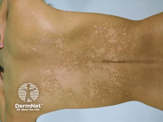 Clinical photography of the back in dorsal/posterior view. The frame shows extensive confluent hypopigmented patches on the upper and mid back with irregular margins and minimal scale. Lesions appear lighter than surrounding skin and coalesce into large hypoesthetic-looking plaques along the scapular region. The overall pattern is diffuse, predominantly on sun-exposed areas of the back, consistent with pityriasis versicolor (tinea versicolor) caused by Malassezia species. There is no erythema, crust, ulceration, or nodularity visible. The skin texture remains intact, and there is no evident lichenification. The color contrast between involved and uninvolved skin is notable, particularly under room lighting; subtle perifollicular fine scaling may be present. This image exemplifies the classic hypopigmented variant rather than hyperpigmented patches. Wood’s lamp examination would be expected to show a coppery yellow-green fluorescence in many cases, aiding diagnosis; KOH preparation may reveal spaghetti and meatballs. Clinically, pityriasis versicolor is common in hot, humid climates and among young adults. Differential considerations include vitiligo, post-inflammatory hypopigmentation, and pityriasis alba. Diagnosis influences management with topical antifungals and, for extensive disease, systemic agents. Educationally, this photo supports recognition, differential diagnosis, and integration of clinical findings with laboratory tests and dermatoscopic correlation.