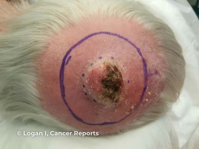 Clinical photography of a solitary scalp lesion prior to wide local excision. Modality: clinical photography with high‑resolution digital color imaging. Anatomical location: scalp skin over the cranial vault; exact laterality not specified. Imaging perspective: frontal/occlusal view bias, close-up of the lesion. The lesion appears as a raised, dome‑shaped to indurated nodule with an erythematous to pink surface, focal crusting, and a central necrotic/ulcerated area. Surrounding perilesional erythema and mild edema are evident; there may be subtle superficial induration at the lesion margins. The circumscribed lesion is outlined in purple ink to aid surgical planning. This morphology raises concern for a high‑grade cutaneous neoplasm, most consistent with pleomorphic dermal sarcoma (cutaneous undifferentiated pleomorphic sarcoma, UPS), a malignant dermal/subcutaneous spindle cell tumor. Differential diagnoses include basal cell carcinoma, squamous cell carcinoma, amelanotic melanoma, keratoacanthoma, spindle cell carcinoma, and other cutaneous sarcomas. The image provides essential preoperative context to guide biopsy strategy, margin planning, and definitive wide excision. Diagnostic significance lies in distinguishing aggressive skin cancers from benign mimics, informing staging, sentinel lymph node assessment considerations, and adjuvant therapy decisions when histology confirms UPS. This preoperative image supports risk stratification and informs multidisciplinary discussion with dermatopathology and surgical oncology.