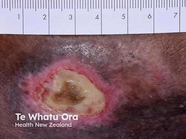 Clinical photography of a well-circumscribed pressure ulcer on the skin with a central necrotic slough overlying a granulating wound bed. The lesion shows a defined, circular/oval outline with surrounding erythema and a thick layer of slough occupying the wound center. A ruler is included in the frame for scale, indicating a lesion diameter of several centimeters. The wound bed demonstrates mixed tissue composition with necrotic slough (yellow-white) atop a pink-to-red granulating base; periwound skin is inflamed. The clinical impression is a chronic decubitus ulcer with suspected underlying osteomyelitis, given the depth and probable bone involvement. No radiographic image is provided; radiology notes would seek MRI or X-ray to confirm osteomyelitis and assess bone marrow edema or cortical disruption. Management implications include aggressive wound debridement, infection control, appropriate antibiotic therapy, and pressure offloading to prevent progression. This image is suitable for wound-care education, clinical case repositories, and decision-support datasets focusing on chronic wounds with osseous involvement. Keywords: pressure ulcer, decubitus ulcer, necrotic slough, osteomyelitis, wound bed, periwound inflammation, granulation tissue, offloading, debridement, antibiotics, MRI, X-ray, infection, chronic wound, dermatology imaging, clinical photography. Clinical relevance includes staging, mobility planning, and multidisciplinary care; potential for necrosis, tunneling, malodor, and systemic sepsis risk if untreated.