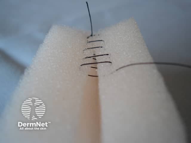 Imaging Modality: clinical photography; technique: macro close-up. The image shows a close-up, top-down view of a fresh linear skin incision closed with a row of interrupted skin sutures. The surrounding tissue is draped on foam to isolate the wound site. Suture material appears dark, likely nylon or polypropylene, with multiple throws creating a tight edge approximation. The wound edges are aligned with minimal gaping, indicating meticulous closure. The epidermis and superficial dermis are visible; underlying subcutaneous tissue may be minimally involved. The field lacks necrosis or purulent collection; no obvious erythema beyond the wound margin. This image demonstrates a standard dermal/subcutaneous closure technique used in minor dermatologic or surgical procedures. The pattern could resemble simple interrupted sutures or a variation of a running knot with several external throws; the exact configuration shows a single vertical suture line with lateral loops viewed schematically. Clinically, this photograph is relevant for education on wound closure principles, suture selection, and post-operative wound care. It aids in differentiating well-approximated wounds from dehiscent or infected wounds, and can be used in sensitive dermatology curricula to illustrate closure quality, suture management, and wound-evaluating criteria in skin surgery.