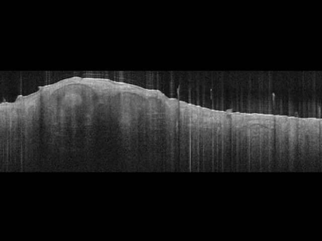 Optical coherence tomography (OCT), spectral-domain, cross-sectional B-scan through the macula. The image depicts the posterior pole retina with a convex, dome-shaped elevation of the neurosensory retina at the foveal/macular region. Retinal layers are present with the inner limiting membrane, nerve fiber layer, outer plexiform/inner nuclear layers, and photoreceptor bands; these strata appear discernible though mildly altered by the contour. The central macula shows mild thickening and a smooth transition between layers, with no prominent subretinal fluid or full-thickness defect evident. Some vertical scan artifacts and speckle noise are visible along the scan lines. Overall, this pattern suggests macular deformation rather than a discrete retinal hole or allows a diagnosis of edema depending on thickness maps. Diagnostic significance centers on objective macular thickness measurement, detection of cystoid spaces, subretinal fluid, or tractional changes at the vitreomacular interface, and monitoring treatment response. Potential clinical use cases include diabetic macular edema, age-related macular degeneration with edema or traction, central serous chorioretinopathy, and evaluation after intraocular surgery. This noninvasive in-vivo retinal imaging enables longitudinal follow-up, correlation with visual acuity, and integration with multimodal imaging such as fluorescein angiography and autofluorescence. Interpretations should be correlated with clinical history and fixed or dynamic visual testing results.