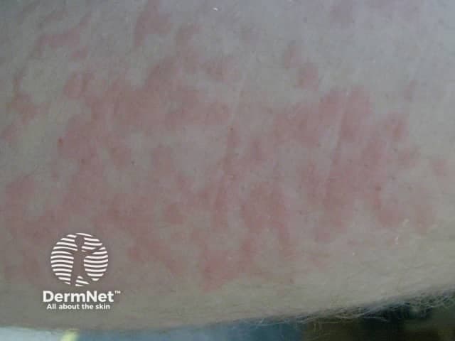 Clinical photography of a cutaneous eruption consistent with cold urticaria. Modality: clinical photograph; technique: standard color photography of exposed skin under diffuse ambient lighting; no staining or contrast. Anatomical location: ventral forearm (exposed integument) showing erythematous, blanchable wheals following cold exposure. Lesions appear as diffuse, pruritic erythematous wheals with slightly raised surfaces; borders are irregular; mild edema within the superficial dermis; lesions may coalesce into larger plaques. Overall, the pattern is mottled erythema with variable intensity, consistent with superficial dermal edema and mast cell–mediated vascular permeability. Pathophysiology: transient dermal edema due to mast cell degranulation triggered by cold stimuli; histology (if biopsy were performed) would show superficial dermal edema with perivascular inflammatory cells and occasional eosinophils. Clinically, onset is rapid after cold contact and resolves within hours after rewarming. Diagnostic significance: supports clinical diagnosis of cold urticaria; helps distinguish from other wheal disorders; ice cube test or temperature-provocation challenges may be used to confirm and stage severity; caution for potential systemic reactions or anaphylaxis with distal cold exposure. Clinical correlation and management: avoid cold exposure, consider non-sedating antihistamines, and document response for educational or research use, including differential diagnoses in teaching cases. This image supports dermatology teaching and case review.