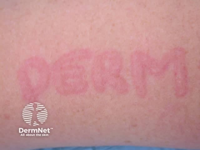 This clinical dermatology photograph depicts a positive dermographism (dermatographic urticaria) response on the skin surface. The imaging modality is clinical photography (Dermatology); technique: close-up, macro shot under consistent lighting to visualize subtle vascular changes. The primary subject is the skin with linearly arranged erythematous wheals produced by light stroking (dermatographism test). Anatomical context: skin, epidermis and superficial dermis. The appearance shows elongated, blanching, reddish plaques along the stroke lines with well-defined margins; the wheals are transient and pruritic, reflecting superficial dermal edema with edema around superficial dermal vessels. Notable features: linear, symmetric or irregular parallel streaks, sharp borders, uniform red-pink color, rapid onset within minutes after mechanical stimulation and resolution thereafter. Diagnostic significance: classic demonstration of physical urticaria due to mast cell degranulation and histamine-mediated increased vascular permeability; supports differential diagnoses including urticaria mechanica, cholinergic urticaria, contact urticaria, and systemic mastocytosis in rare cases. Clinical correlation: correlate with history of itching, trigger exposure to friction, clothing, or pressure; management includes nonsedating antihistamines and trigger avoidance; useful for patient education and medical training. This image is not stained or derived from histology. Annotations underscore intact integument with no pigmentary alteration beyond transient erythema; suitable for clinical teaching, case libraries, and AI training datasets.