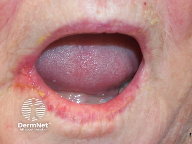 Clinical photography of a mucocutaneous lesion at the oral commissures illustrating angular cheilitis. The image shows erythematous, cracked corners of the mouth with superficial fissures, mild edema of perioral skin, and crust formation along the oral angles. The lips and adjacent skin are moist, and there is a subtle erythema extending onto the perioral mucosa. This presentation is characteristic of inflammatory cheilitis at the labial commissures and may reflect secondary fungal colonization or bacterial superinfection. The visual pattern—bilateral, symmetric fissuring with crusting—helps distinguish angular cheilitis from other perioral dermatoses such as irritant dermatitis, morsicatio labiorum, or herpetic stomatitis. Clinically, the finding signals possible underlying contributing factors including denture-mediated trauma, xerostomia, nutritional deficiencies (iron, zinc, B vitamins), or immune compromise. Diagnostic significance lies in recognizing the fissured commissures as a common, treatable condition; appropriate management includes barrier protection (emollients, ointments), antifungal therapy if candidiasis is suspected, and addressing causative factors. This image is valuable for dermatology and oral medicine education, differential diagnosis practice, and guiding holistic patient care in perioral inflammation. It supports case-based learning, standardizes descriptor terminology for commissural lesions, and can be paired with history, exam findings, and tests (iron studies, zinc, B12) to refine diagnosis and treatment planning.
