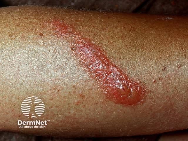 This is a clinical skin photograph illustrating a plant-induced contact dermatitis on the forearm. Modality: clinical photography using visible light; single, close-up field; no dermoscopic illumination. The primary subject is the epidermal and superficial dermal inflammatory response to plant sap exposure. The lesion is a linear, erythematous plaque along the extensor forearm, with a glossy surface, uneven but clearly demarcated border, and mild surrounding edema. In some areas the surface appears slightly vesicular or bulla-like, suggesting early vesiculation; scale is minimal. The surrounding skin shows occasional petechial or punctate spots consistent with irritation. The color ranges from bright red to pink, with intermediate zone of lighter erythema. No regional lymphadenopathy visible. The lesion distribution mimics a contact sheath pattern typical of plant allergen contact dermatitis (e.g., urushiol-containing plants). Diagnostic significance: pattern recognition supports allergic or irritant contact dermatitis to plant resin; correlates with exposure history; differential includes phytophotodermatitis, dermatitis medicamentosa, eczema, and infection if secondary. Clinical correlation: obtain exposure history, confirm plant contact (poison ivy, oak, sumac, or other sap-producing flora), assess pruritus and burning, educate on avoidance and patch testing if persistent. Potential use cases: clinical teaching, derm training corpus, teledermatology, AI dataset for dermatitis recognition, search indexing.