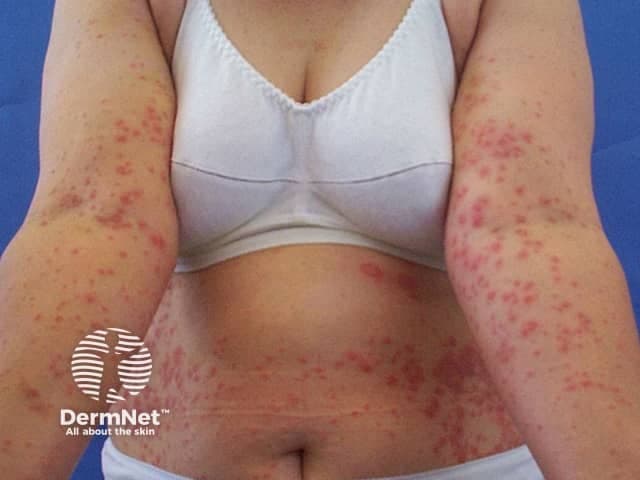 Clinical photograph of extensive neutrophilic dermatosis consistent with Sweet syndrome. Modality: color clinical photography of exposed and covered surfaces under standard white-light illumination. Findings: widespread, symmetric eruption involving the trunk and both proximal arms with numerous erythematous papules and plaques, some with subtle edema and superficial crusting. Lesions are tender on palpation and may coalesce into larger plaques, creating a figurate, arcuate, or annular morphology in places. The color is bright to violaceous red, with sharp borders against surrounding normal skin. Distribution is truncal and limb-centric, no mucosal involvement evident in the supplied views. Interpretation: the dermal eruption is characteristic for an acute febrile neutrophilic dermatosis (Sweet syndrome) and should prompt evaluation for systemic associations including hematologic malignancy, infection, inflammatory disorders, or drug exposure. Correlation with fever, leukocytosis, and elevated inflammatory markers strengthens the clinical diagnosis. If biopsy is performed, histopathology typically shows dense neutrophilic infiltrate in the upper dermis with edema and absence of vasculitis. Differential diagnoses include erythema nodosum, erythema multiforme, leukocytoclastic vasculitis, and drug eruption. The image supports dermatologic assessment, guides workup for underlying disease, and monitors treatment response to systemic corticosteroids or immunomodulatory therapy. This phenotype is essential for education, differential diagnosis practice, and research on neutrophilic dermatoses.