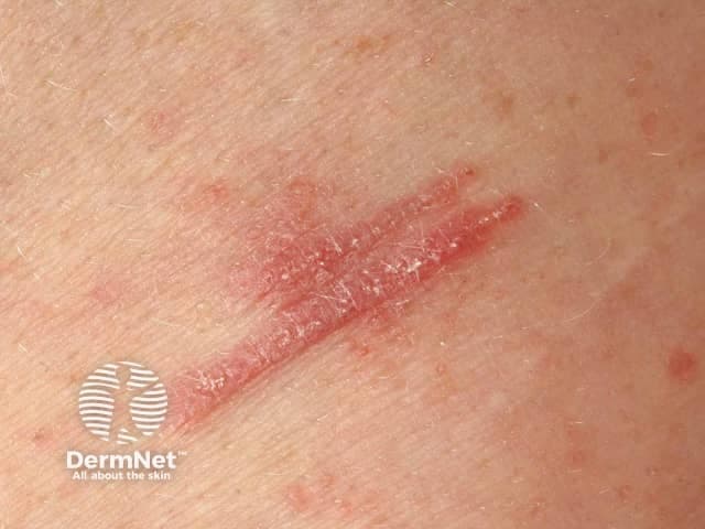 Clinical photograph demonstrating Koebner phenomenon in lichen planus. Modality: in vivo color image acquired with standard clinical photography using visible light; perspective: close‑up, surface view of the skin, showing a linear trajectory along a history of trauma. Anatomical context: integumentary system; skin (cutaneous tissue); epidermis with superficial dermis involvement; location not specified on the body; region described as a linear band on a trunk/limb surface; laterality not indicated. Visual features: a linear, plaque‑like lesion composed of erythematous to mildly violaceous linear band, with slight desquamation and a glossy surface; margins are relatively well defined; surrounding skin shows additional punctate papules and subtle erythema. The lesion aligns with a scratch or trauma line, illustrating the Koebner response in lichen planus. Pathophysiology: lichenoid inflammation triggered by cutaneous trauma leads to linearization of LP lesions; hallmark features may include Wickham’s striae not visible in this image. Diagnostic significance: supports a clinical diagnosis of lichen planus with Koebnerization; may help differentiate from linear psoriasis or lichen striatus in ambiguous cases and prompt correlation with history and biopsy if needed. Clinical context: management favors trauma avoidance, topical steroids, calcineurin inhibitors, and close monitoring for mucocutaneous involvement; educate patient about triggering events.