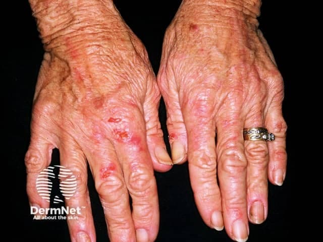 This clinical photograph shows bilateral dorsal surfaces of the hands in an elderly patient. The skin demonstrates chronic, erythematous plaques with fine scaling and superficial erosions greatest over the dorsum of the fingers and metacarpophalangeal joints. The plaques are irregular in shape, with a xerotic, dry appearance and areas of mild lichenification suggesting chronic rubbing or scratching. Subtle edema is present around the knuckles, and the overall skin surface appears coarse and wrinkled consistent with aging. No obvious vesicles, purpura, or open ulcers are seen. The ring and fingernails are normal in morphology apart from minor cuticular shedding; no prior surgery is evident. The color balance is accurate for a skin-tone photograph; lighting is even with minimal shadowing, enabling evaluation of surface texture, scale, and lesion distribution. This pattern, bilateral and symmetric involvement of the dorsal hands with erythematous, scaly patches, fits chronic dermatitis etiologies such as irritant contact dermatitis, allergic contact dermatitis, or atopic dermatitis (eczema), with dyshidrotic eczema as a less likely differential in this location. Clinical correlation should include history of irritant exposure, cosmetic or cleansing products, and pruritus. Management implications include emollient therapy, barrier protection, topical corticosteroids, and consideration of patch testing to identify triggers today.