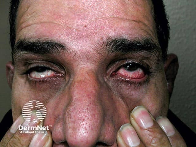 Imaging modality: Digital clinical photography of the ocular region, frontal facial view focusing on the eyelids, periorbital tissues, and anterior segment. The subject shows bilateral red eyes with conspicuous conjunctival injection and scleral/episcleral erythema; surrounding eyelid and lid-margin tissues appear mildly swollen. Anatomical context centers on the anterior ocular structures, including conjunctiva, episclera, and sclera, within the orbit; the view highlights vascular dilation and diffuse hyperemia consistent with inflammatory processes rather than infectious discharge. The differential includes scleritis, episcleritis, conjunctivitis, and iritis; distinguishing features may include depth of scleral involvement, tenderness, and pain intensity not fully captured in a still image. In relapsing polychondritis, ocular inflammation often accompanies systemic cartilage involvement and can herald flares; thus, clinicians should correlate with ENT, rheumatology findings, and systemic inflammatory markers. Diagnostic significance lies in recognizing autoimmune ocular involvement that necessitates systemic immunomodulatory therapy rather than topical antibiotics alone. Potential clinical utilities include documenting disease activity, guiding treatment escalation, educating learners about RP-associated eye findings, and serving as a reference for case-based discussions on autoimmune uveitis spectrum. This image illustrates how RP can present with red eyes due to scleritis/episcleritis/conjunctivitis/iritis, aiding differential diagnosis and interdisciplinary management. Representative RP ocular involvement warrants early rheumatology collaboration.