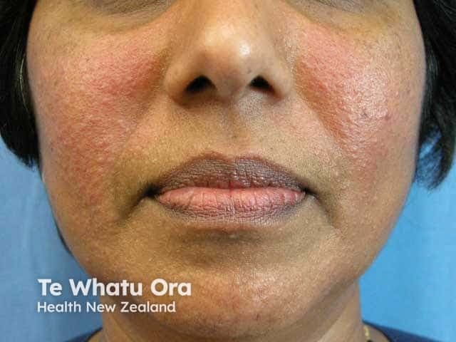 Clinical photography of the face in frontal orientation. The image depicts symmetrical erythematous papules on the malar cheeks with diffuse background erythema, mild textural roughness, and slight scaling. No pustules, comedones, or crusts are conspicuous in this field. The overall appearance is consistent with papulopustular rosacea localized to the central face, particularly the malar regions, with preserved perioral and nasal skin. The lips appear normal aside from mild dryness. Lighting is neutral and color-accurate, allowing reliable assessment of redness intensity and lesion distribution. This photograph documents active inflammatory facial dermatitis and can be used to grade severity, monitor therapeutic response, and educate patients about rosacea triggers. Clinically, the malar predominance helps distinguish rosacea from acne vulgaris, seborrheic dermatitis, or contact dermatitis; absence of comedones further supports rosacea over acne. In practice, management implications include initiation of anti-inflammatory topical therapy (e.g., metronidazole, azelaic acid) or systemic therapy (doxycycline) and strict sun protection. The image supports research in rosacea phenotyping and outcome measures for treatment trials. It is suitable for dermatology training, teledermatology assessments, and patient counseling about disease recognition and prognosis. Additional notes include documenting any ocular symptoms, eyelid involvement, or facial edema to guide comprehensive care for multidisciplinary management planning.