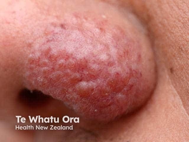 Imaging modality: Clinical dermatologic photography of a localized cutaneous plaque on the left nasal ala. The lesion is an indurated, erythematous-to-violaceous plaque with a rough surface and subtle nodularity, coalescing into a conspicuous patch along the ala nasi. The appearance is classic for lupus pernio-like cutaneous sarcoidosis, though biopsy is often required for definitive confirmation. The image emphasizes surface texture with increased dermal density and faintly infiltrated margins against surrounding normal facial skin. Involvement is confined to the external nose region; no adjacent mucosal ulceration or necrosis is evident in this view. The lesion color ranges from reddish to purplish pink, reflecting granulomatous inflammation beneath the epidermis. Clinically, such plaques may precede systemic sarcoidosis or accompany pulmonary, ocular, or multiorgan involvement; thus, this photo is valuable for differential diagnosis and educational case discussion. When compared with other granulomatous dermatoses, this presentation helps distinguish sarcoid skin lesions from infectious etiologies or rosacea variants. Potential clinical applications include guiding biopsy planning, monitoring therapeutic response to corticosteroids or steroid-sparing agents, and prompting systemic evaluation for sarcoidosis. This image serves as a teaching example for dermatologists, radiologists, and medical trainees studying cutaneous markers of systemic granulomatous disease. Clinical relevance includes monitoring progression and response.