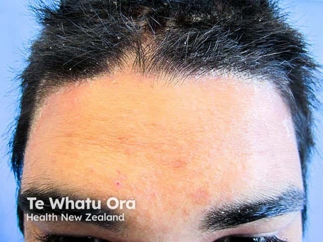 Clinical photography of facial skin demonstrating plaque-type psoriasis along the anterior hairline. Modality: Dermatologic clinical photography; frontal view of the forehead and frontal scalp margin under standardized lighting. The image depicts erythematous, well-demarcated plaques with mild to moderate scaling confined to the anterior hairline and forehead, extending along the temporal margins in places. The surrounding skin shows mild erythema without active oozing. The plaques appear slightly infiltrated with silvery scales, consistent with plaque psoriasis. No swelling of underlying subcutaneous tissues is evident. The hair follicles appear preserved; no ulceration or crusting. The distribution is focal to the hairline region, a common site for facial psoriasis, which may resemble seborrheic dermatitis but differs by the extent and silvery scale. Clinically, this finding supports a diagnosis of psoriasis vulgaris with facial involvement; it may correlate with psoriatic plaques at other sites. This image is useful for dermatology education, patient counseling, and longitudinal assessment of treatment response to topical corticosteroids or vitamin D analogs. Potential differential diagnoses include seborrheic dermatitis, eczema, contact dermatitis, and less likely fungal infection. Clinical correlation with patient history and examination of palms, elbows, knees, and nails is recommended for comprehensive assessment. Useful for therapy planning and ongoing monitoring.