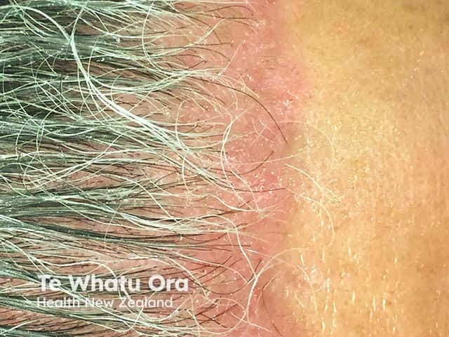 Clinical photography of the frontal scalp and anterior hairline demonstrates plaque psoriasis involvement. The image shows erythematous, well-demarcated plaques along the hairline and extending onto the forehead with fine silvery scales. Lesions are located on sun-exposed facial/forehead skin around the temples and brow region, with involvement of hair-bearing skin and adjacent non-hair-bearing skin. The plaques display classic psoriatic features: erythema, prominent scaling, and mild desquamation, with edge accentuation at hair follicle openings. The skin between plaques remains largely uninvolved, and there is no evident crusting or oozing in this view. The appearance is consistent with plaque psoriasis (psoriasis vulgaris) rather than seborrheic dermatitis, tinea faciei, or atopic dermatitis; however, atypical mimickers exist. The image is captured in a frontal/anterior view using standard color photography, suitable for documenting disease extent on the hairline and forehead. These findings have diagnostic significance in supporting a psoriasis diagnosis and in guiding topical therapies and subsequent phototherapy planning. Clinically, recognizing localized facial/forehead psoriasis impacts management decisions and prognosis, as facial involvement may require gentler formulations and careful irritation minimization. Potential clinical use cases include dermatology education, teledermatology assessment, monitoring treatment response, and research on facial psoriasis phenotypes.